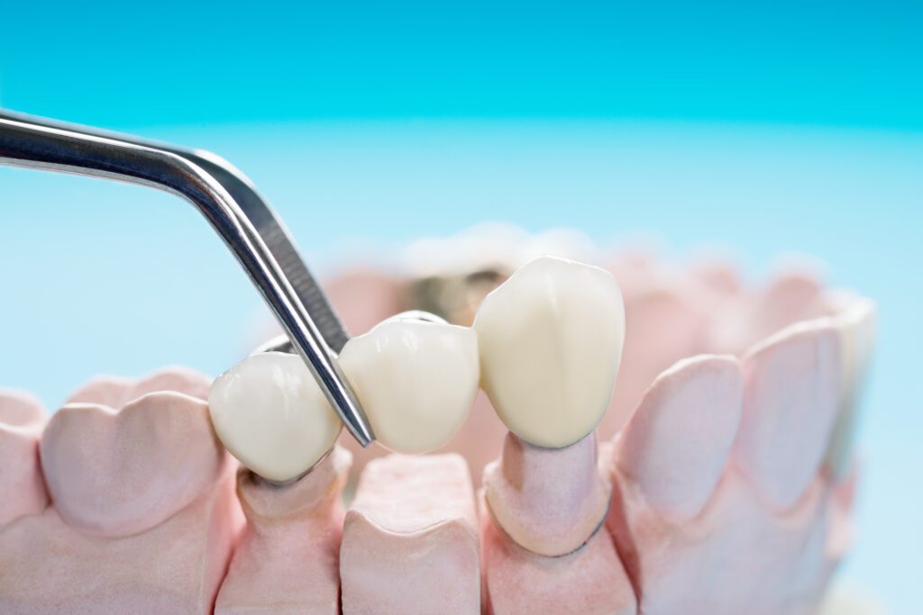 Dental Bridges for Optimal Comfort