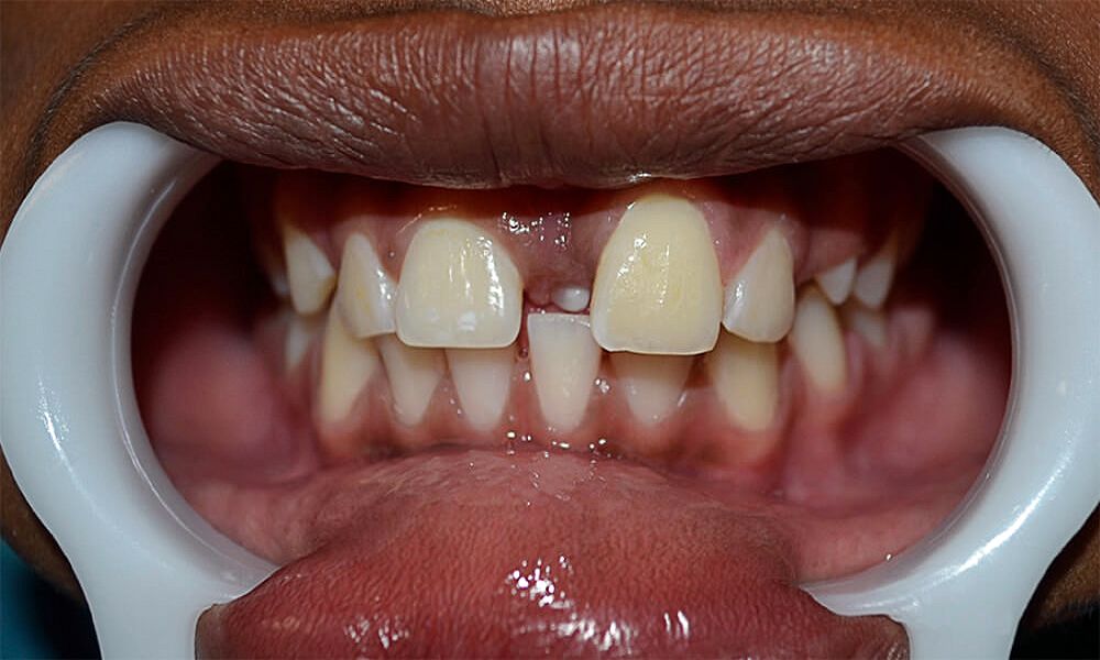 diastema