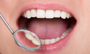 Composite Fillings