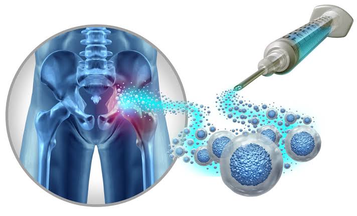 How Stem Cell Therapy May Support Joint Health