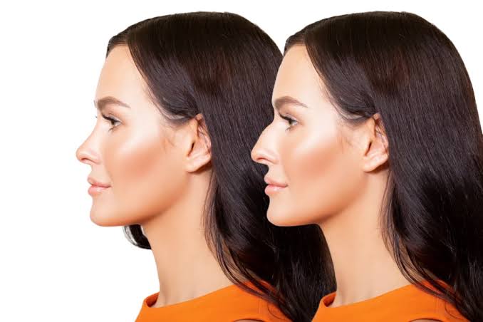 HOW MUCH DOES RHINOPLASTY IN BARCELONA COST? WHAT ACTUALLY DETERMINES THE PRICE